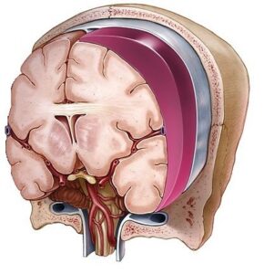 Hematoma subdural, ¿qué es?
