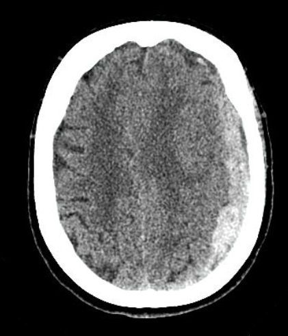 Hematoma subdural