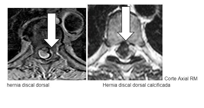Hernia discal dorsal